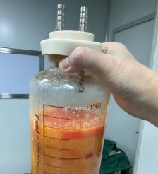 儋州水动力吸脂手术要做多久？